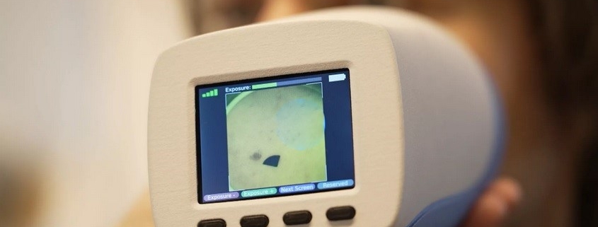 Un nuovo dispositivo permette uno screening rapido del melanoma