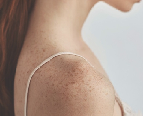 Lotta contro il melanoma: compiuto un passo avanti rivoluzionario
